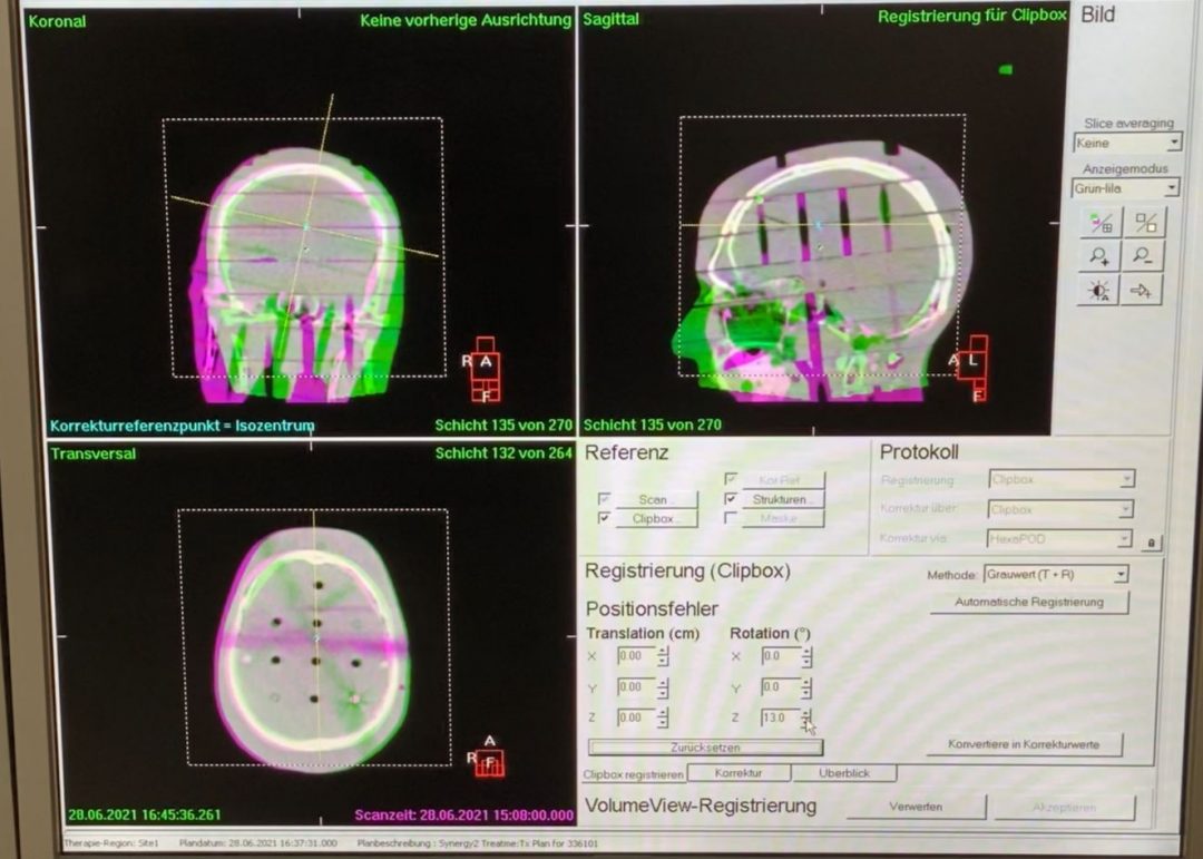 Radiotherapy mask head and neck - Adjustable head support